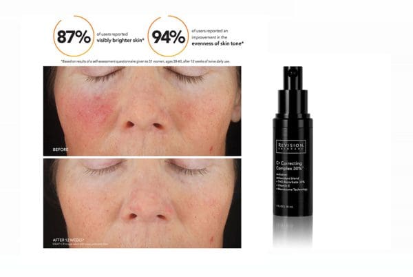 Correcting Complex 30% from Danik MedSpa