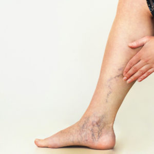 Legs Laser Vein Removal