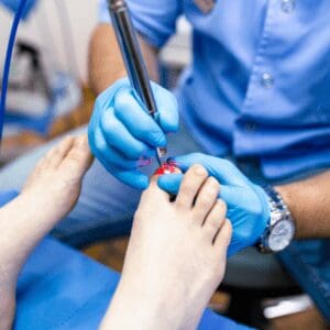 Laser Nail Fungus Treatments