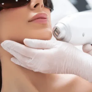 Laser treatment on a woman’s chin for hair removal.