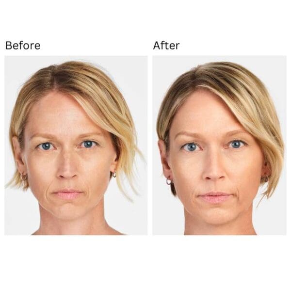 Full Face Rejuvenation Radiesse - Image 2