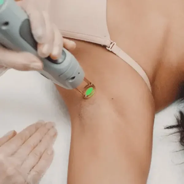 Laser hair removal treatment on underarm area.