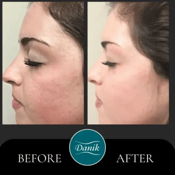 Microneedling & BioRePeel Perfection - Image 4