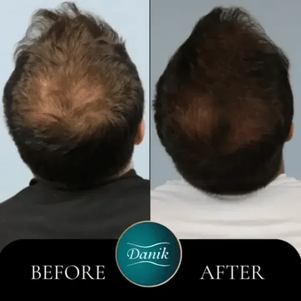 PRP Hair Growth Without Surgery - Image 3