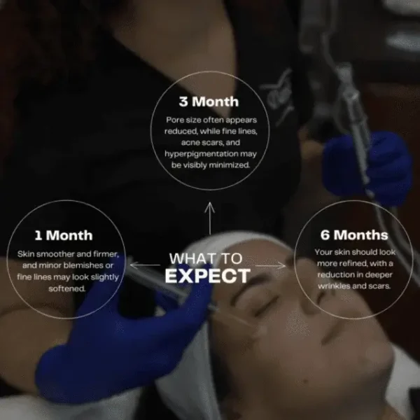 Glow Renewed: PRP Microneedling Magic - Image 2