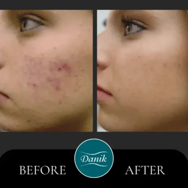 Stem Cell-Enhanced Microneedling - Image 3