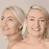 Radiesse and Danik Facial