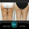 Venus Legacy Body Contouring - Image 2
