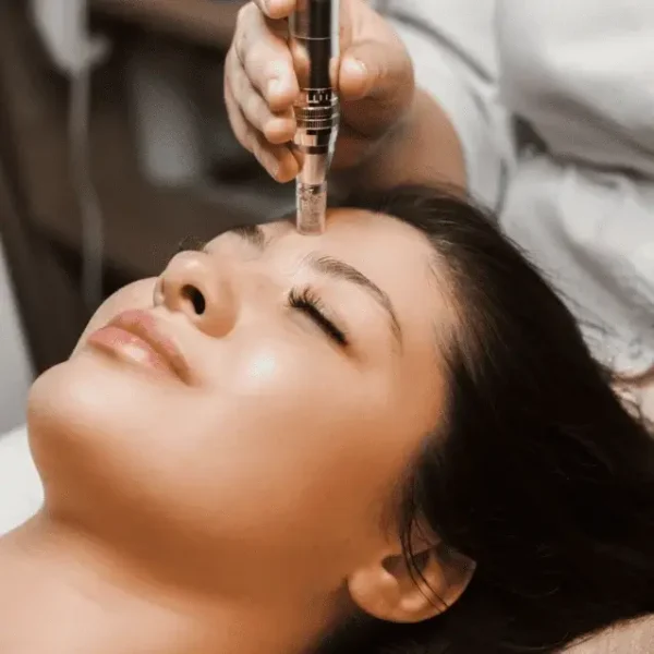 Woman undergoing microneedling with stem cell therapy for skin rejuvenation.