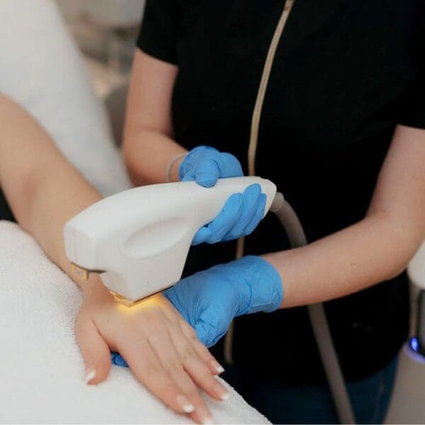 IPL Hand Rejuvenation