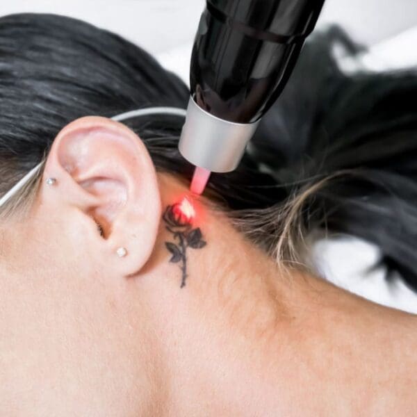 Advanced Laser Tattoo Removal - Small Size