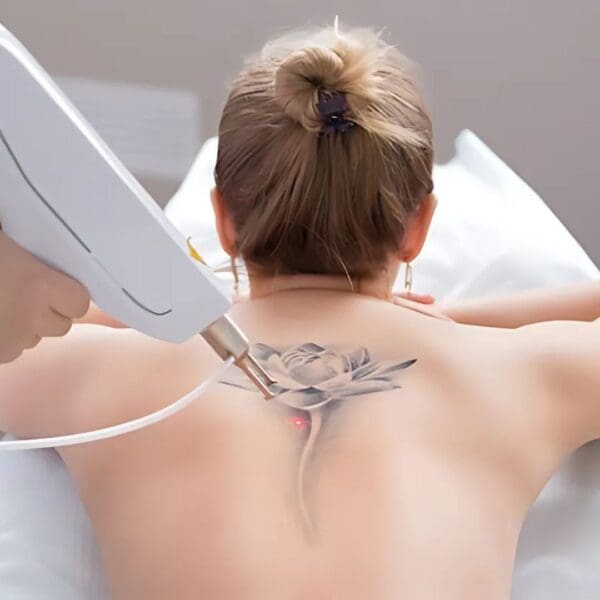 Advanced Laser Tattoo Removal - Large Size