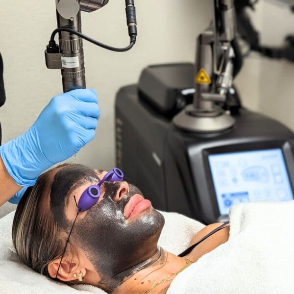 Carbon Laser Peel Treatment