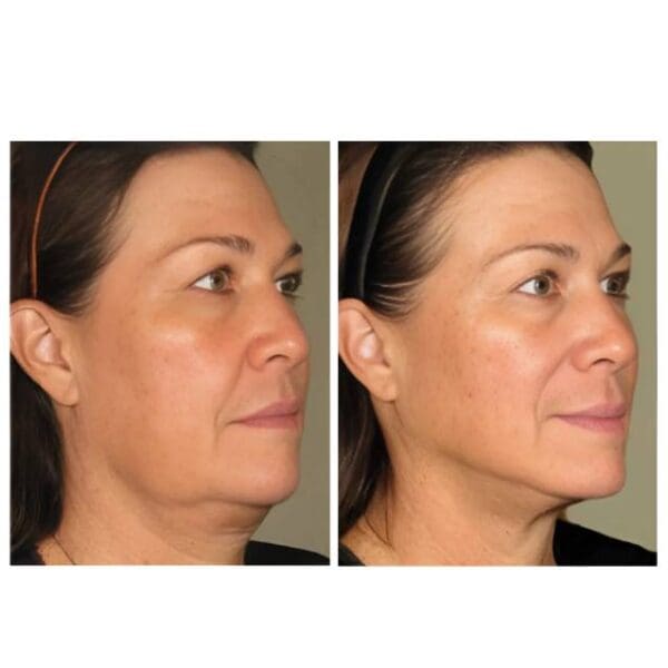 Face Lift Non-Surgical Ultherapy - Image 2