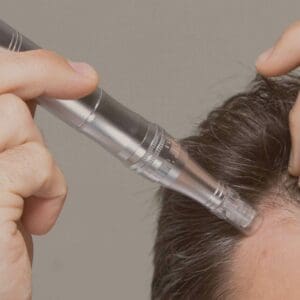 PRP with Microneedling for Hair Growth and Facial