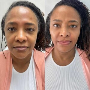 Full Face Balance for Facial Harmony