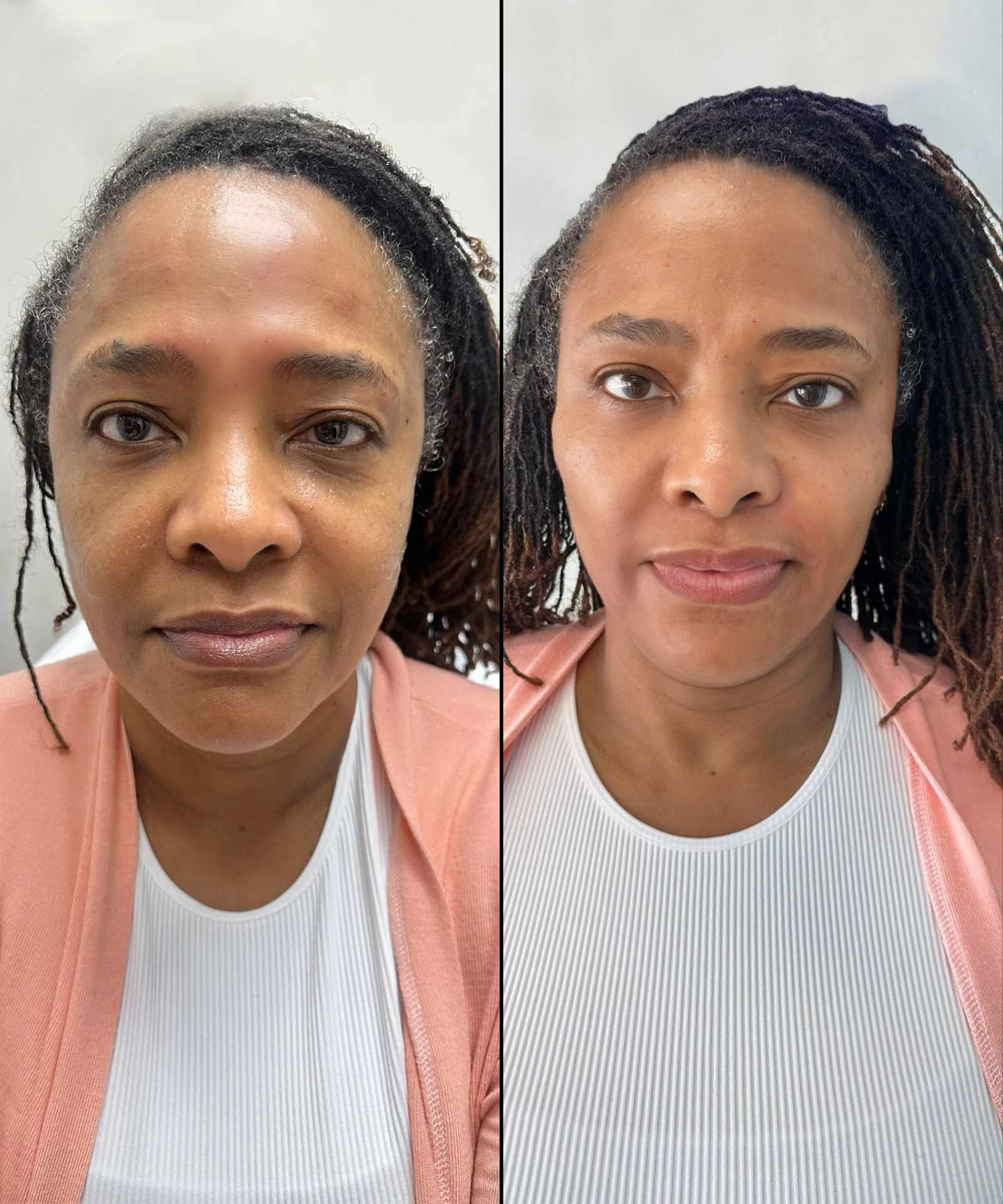 Full Face Balance for Facial Harmony