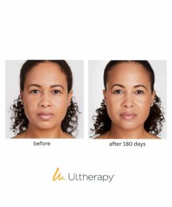 V Line Lift for Lower Face & Gift Brow Lift & Gift Venus Face