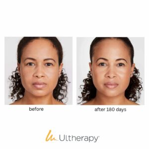 V Line Lift for Lower Face & Gift Brow Lift & Gift Venus Face