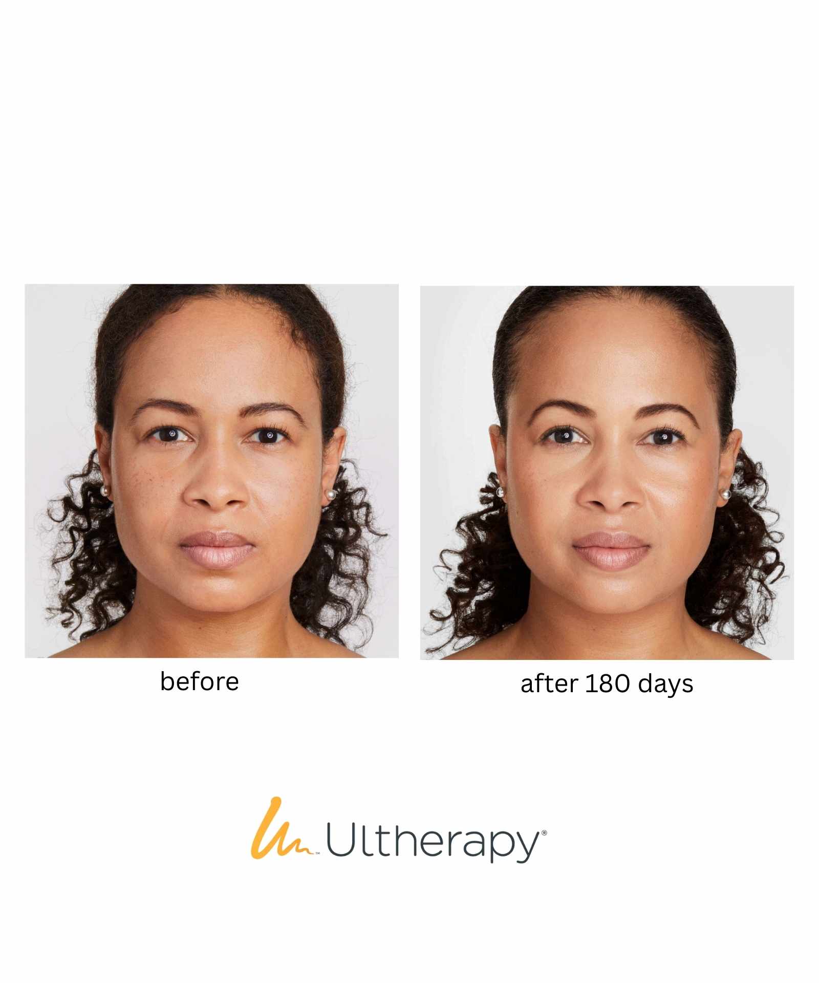 V Line Lift for Lower Face & Gift Brow Lift & Gift Venus Face