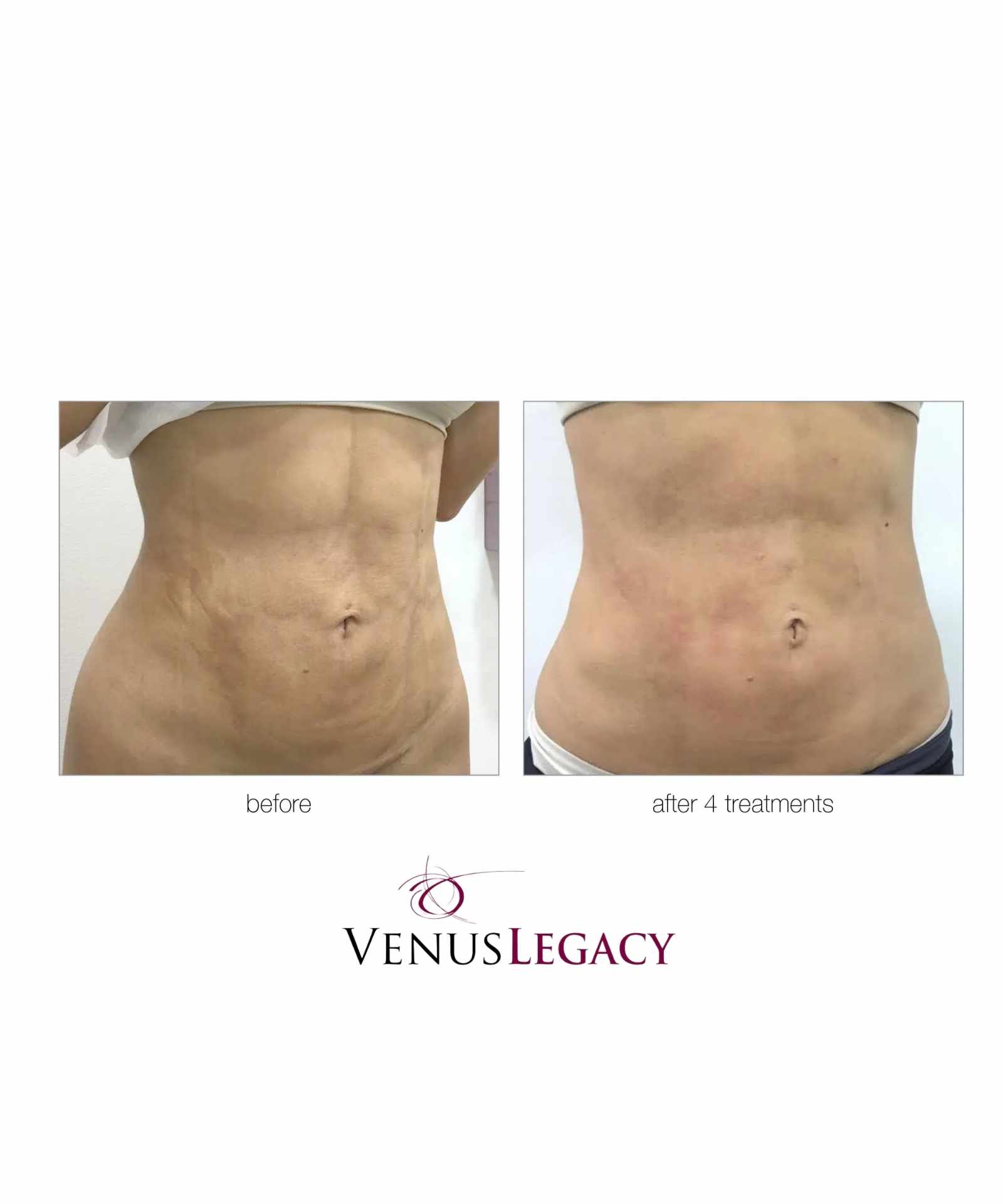 Venus Legacy and Shockwave for Stubborn Belly Fat - Image 2