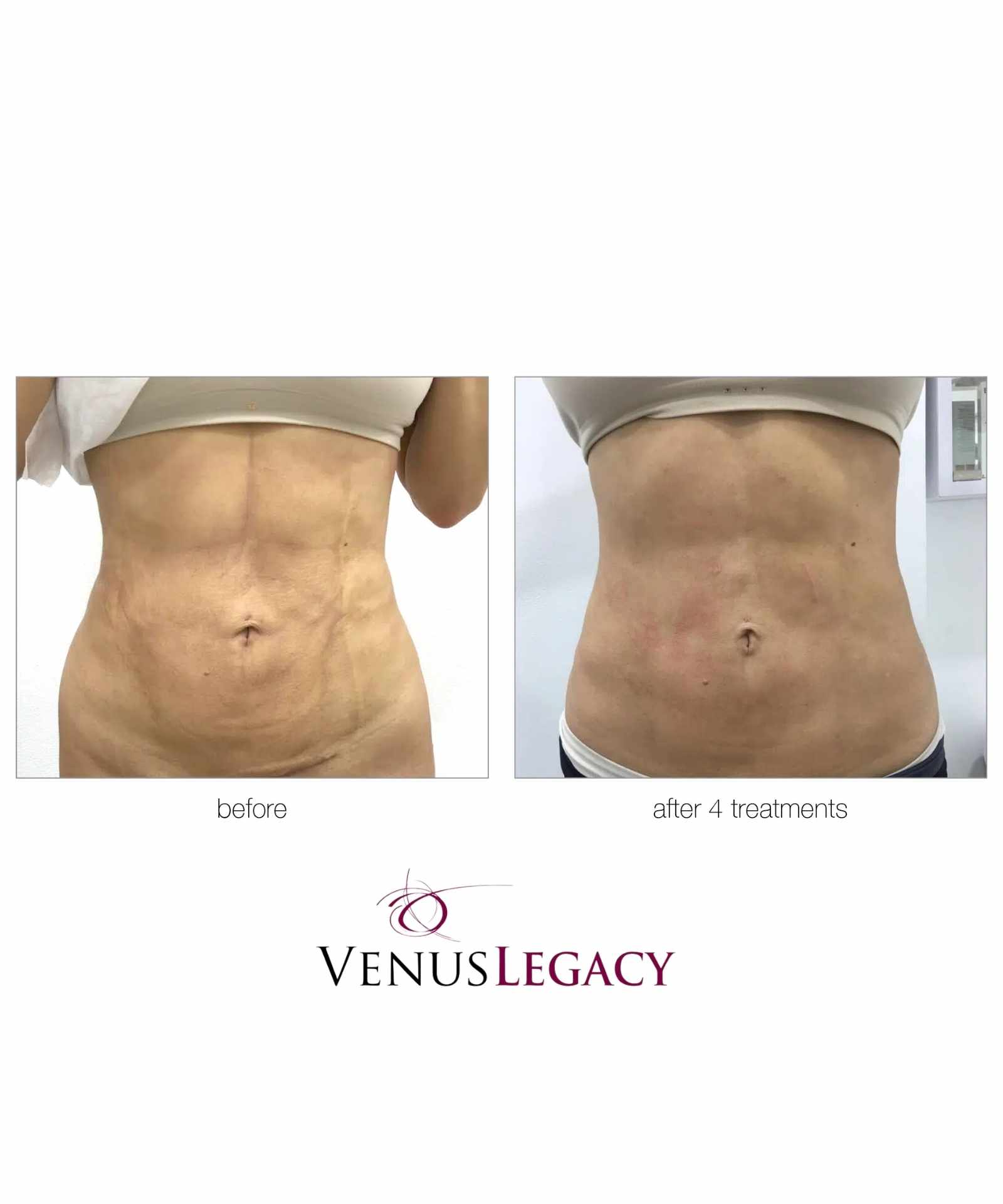 Venus Legacy and Shockwave for Stubborn Belly Fat - Image 3