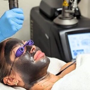 CARBON LASER PEEL