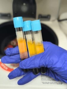 PRP Hair Loss
