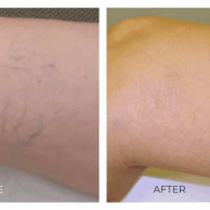 VEIN REMOVAL TREATMENT