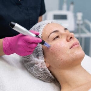Microneedling & Exosomes Ultimate Glow