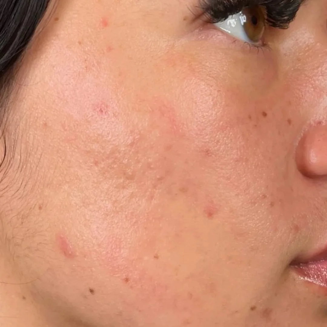 After BioRePeel skin renewal peel: clearer, smoother and more even skin