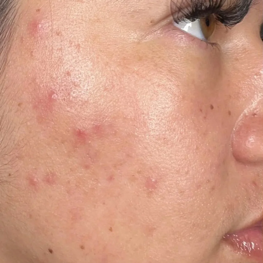 Before BioRePeel skin renewal peel: cheek with acne breakouts and redness