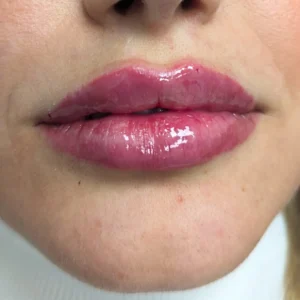 HA Lip Filler for Plump and Defined Lips