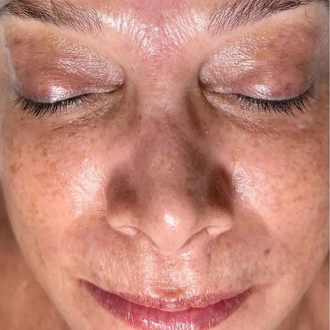 After facial skin rejuvenation treatment: smoother, brighter and refreshed skin