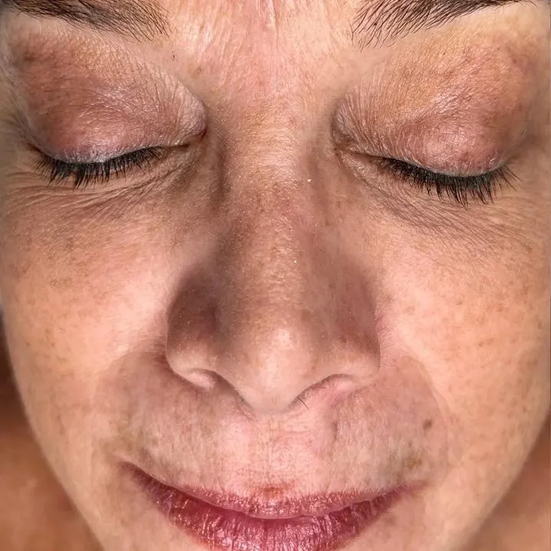 Before facial skin rejuvenation treatment: skin with fine lines and uneven texture