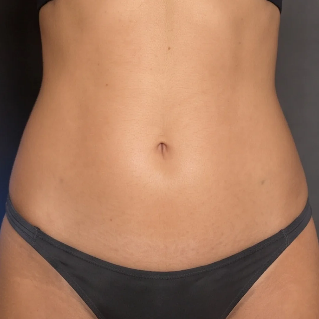 After Tirzepatide and Venus Nova treatment: slimmer, toned and tightened abdomen