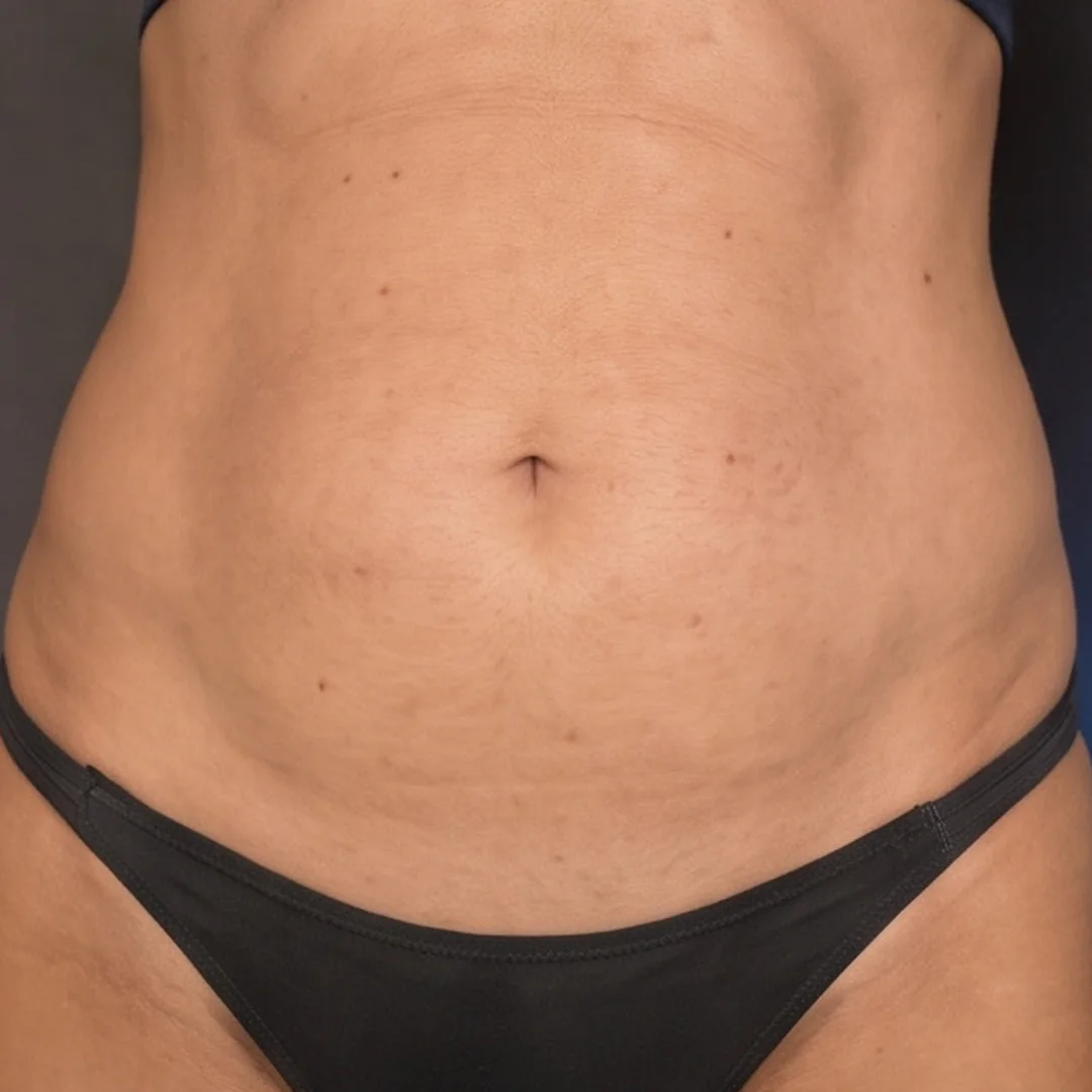 Before Tirzepatide and Venus Nova treatment: abdomen with stubborn belly fat